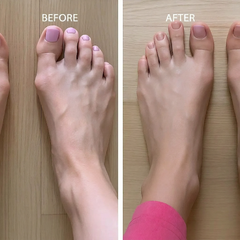 OrthoSoft™ Bunion Corrector